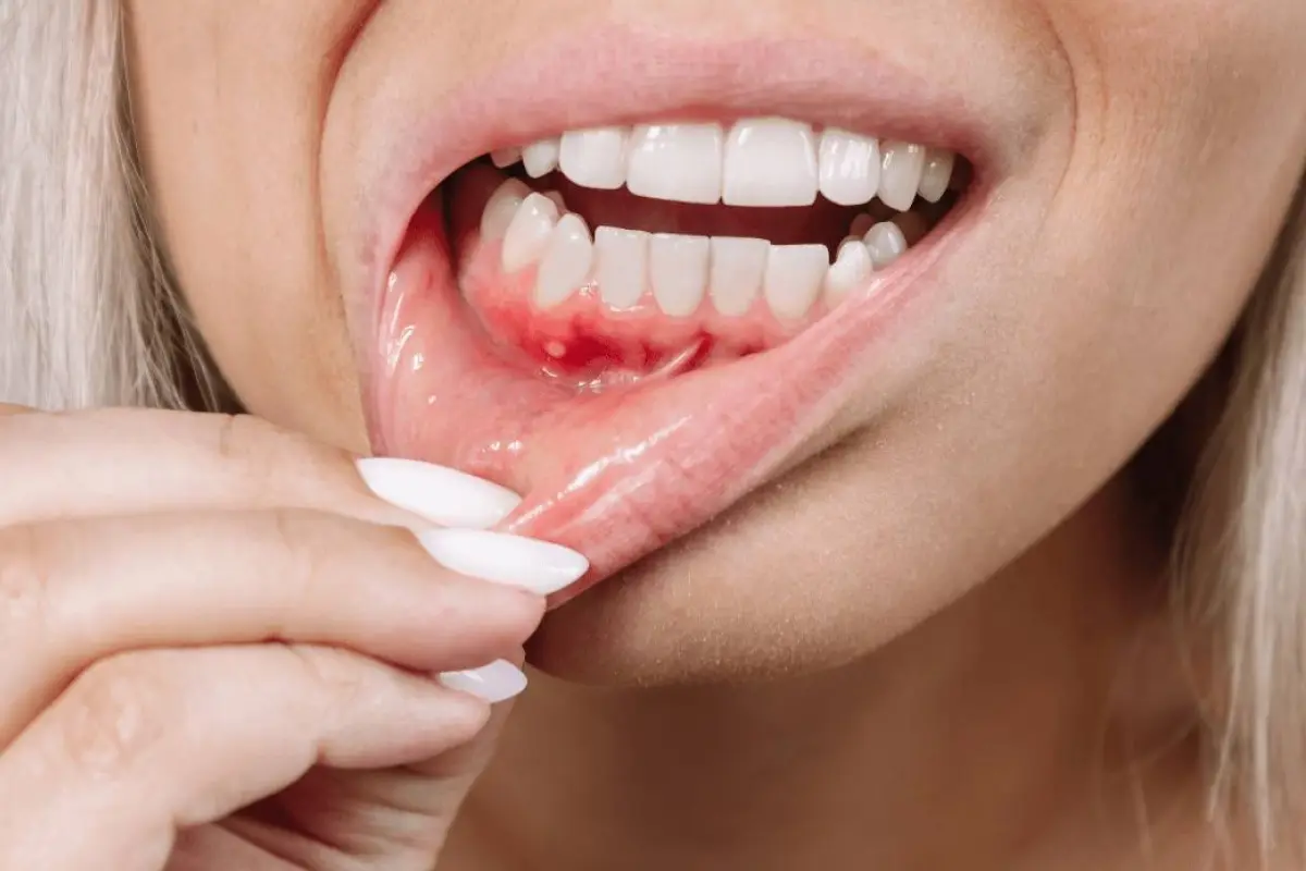 Periodontitis y cáncer colorrectal: una relación más estrecha de lo que parece