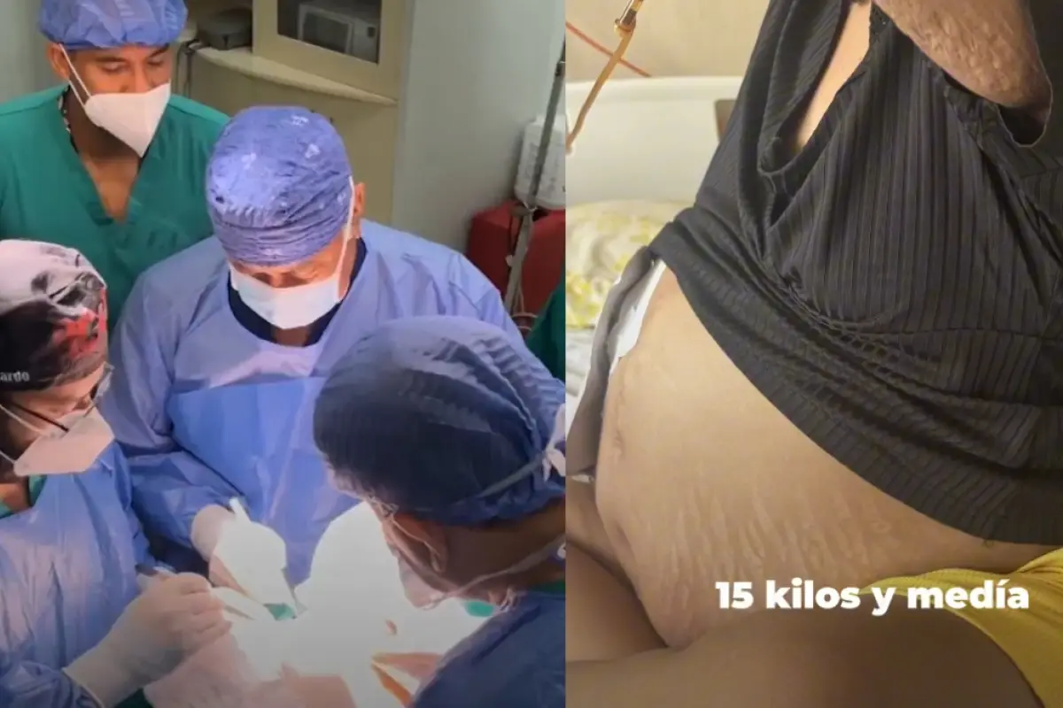 Una mujer vivía con un tumor de 30 libras, la neoplasia le fue extirpada a la paciente en un hospital del IESS en Guayaquil. (IESS)