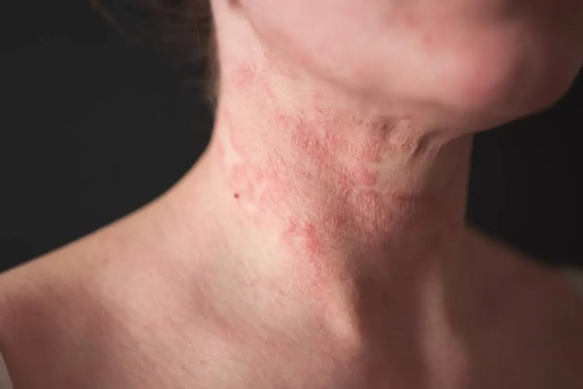 No solo afecta a la piel La dermatitis atópica también provoca cansancio, frustración y ansiedad, La enfermedad provoca piel extremadamente seca y un picor (prurito) intenso y persistente.