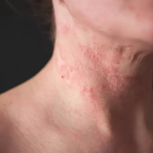No solo afecta a la piel: La dermatitis atópica también provoca cansancio, frustración y ansiedad