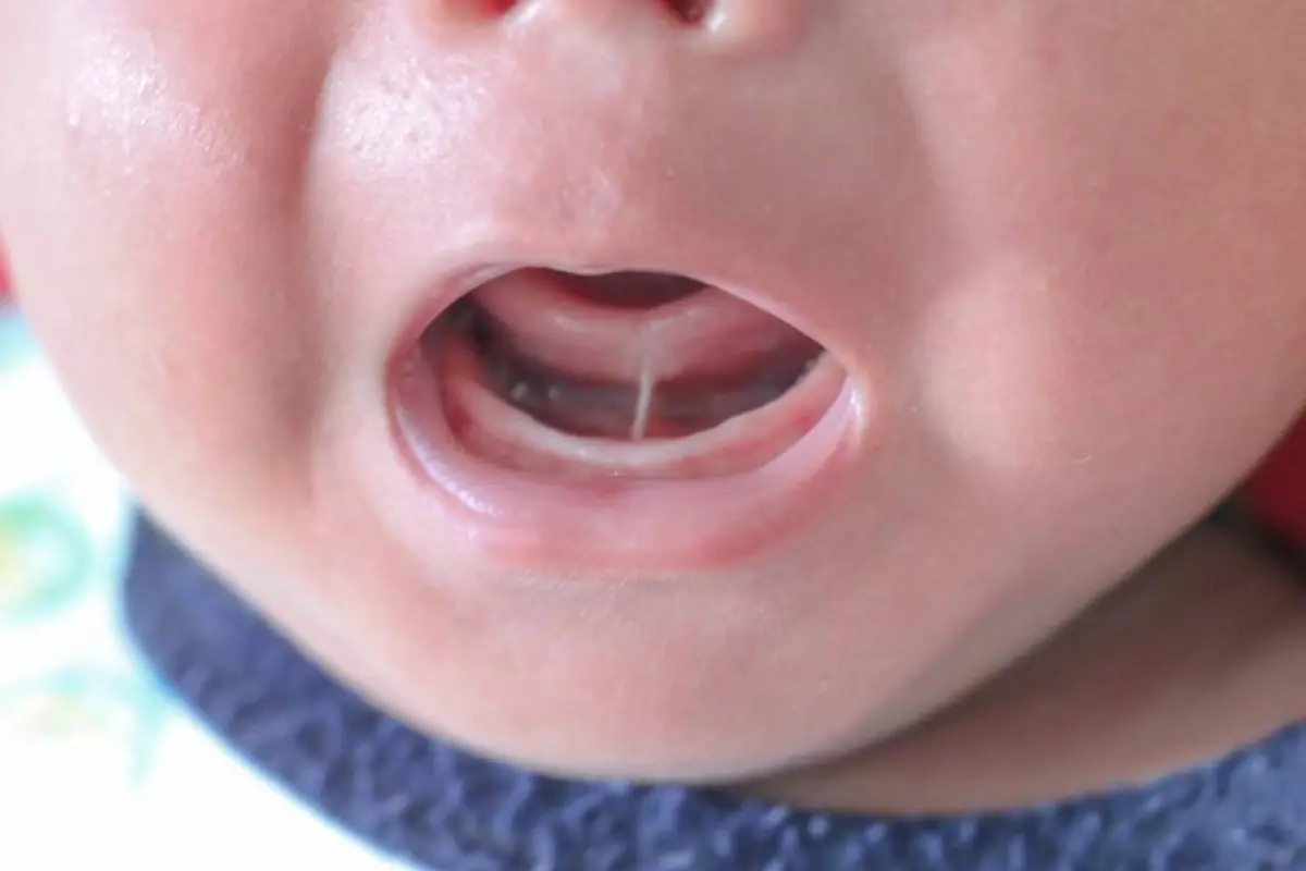 Investigación internacional asocia anquiloglosia con apnea del sueño en niños, Europa Press.