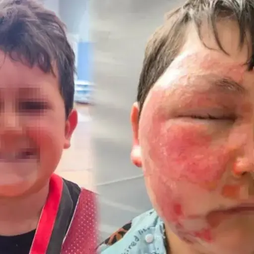 Niño de nueve años sufre quemaduras graves tras imitar un reto viral en redes sociales
