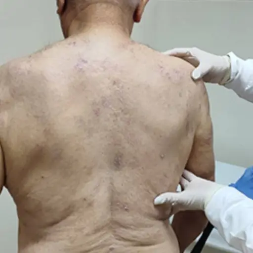 Hospital del IESS de Portoviejo implementa clínica de autoinmunes para pacientes dermatológicos