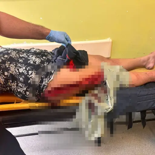 Adolescente de 16 años sufre accidente en moto en El Carmen