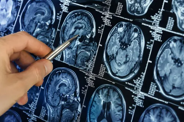 La esclerosis múltiple afecta el cerebro y la médula espinal, alterando diversas funciones del organismo. ,Cortesía.