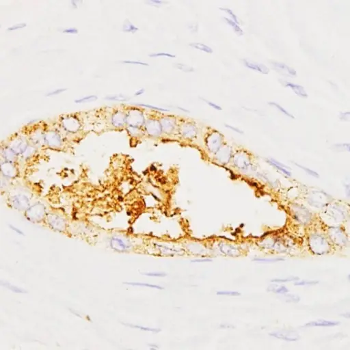 Investigadores españoles crean un prototipo de test para detectar cáncer de páncreas “en minutos” con muestras de sangre