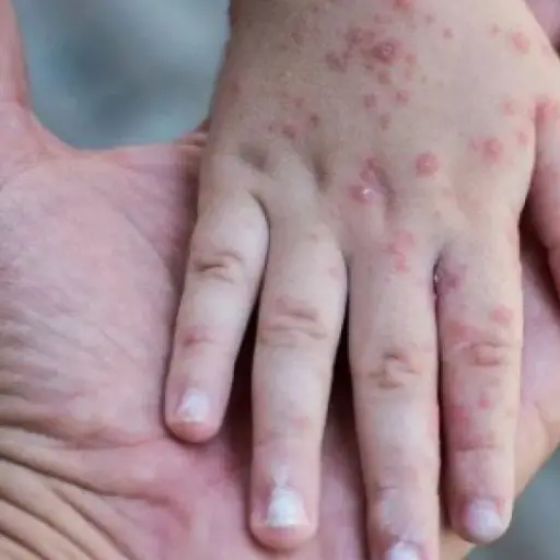 Autoridades británicas alertan por incremento de casos de sarampión y refuerzan llamado a la vacunación