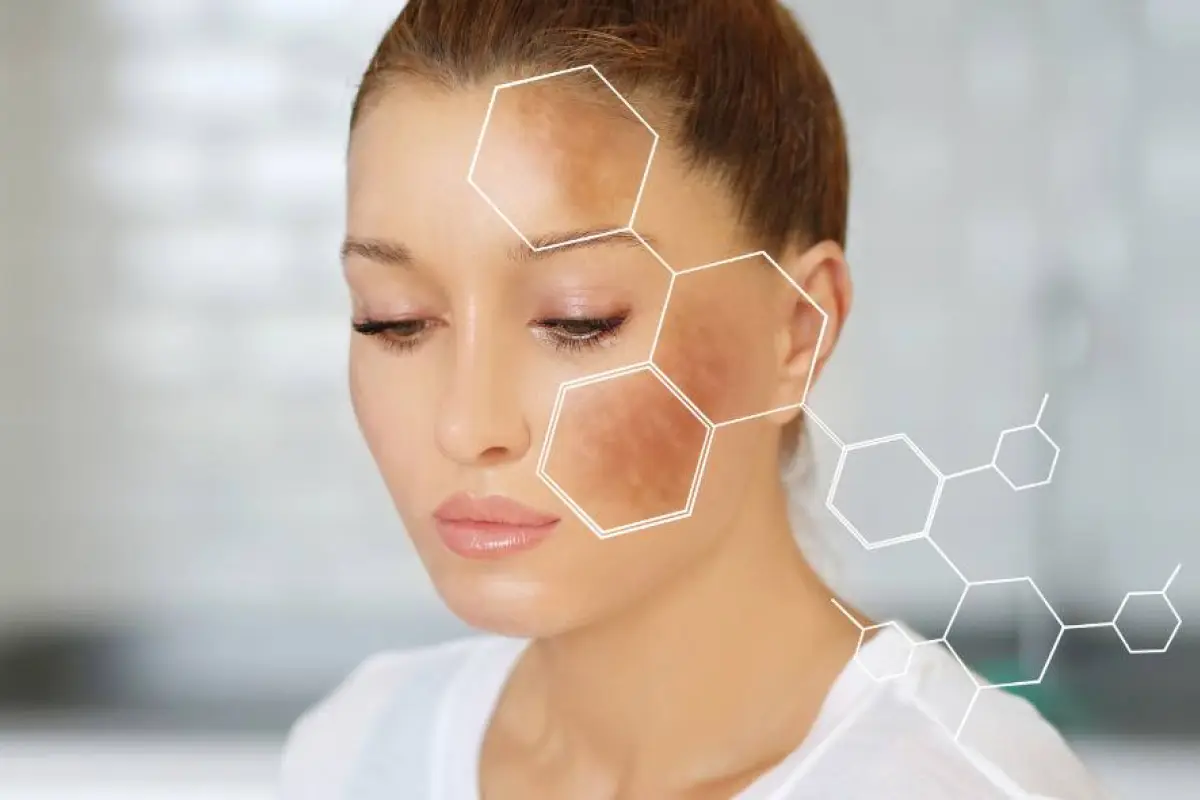 El melasma impacta fuertemente en la autoestima de las personas.