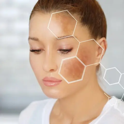 ¿Por qué aparecen manchas en la cara?: Descubre qué hacer frente al melasma